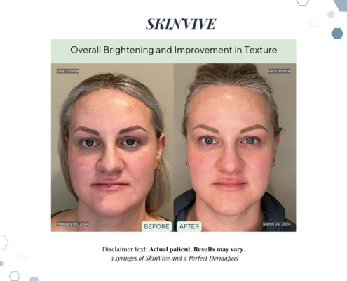 Before and After - In progress - 25