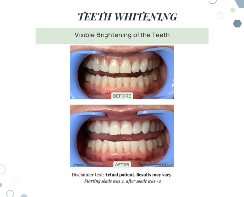 Before and After - In progress - 59
