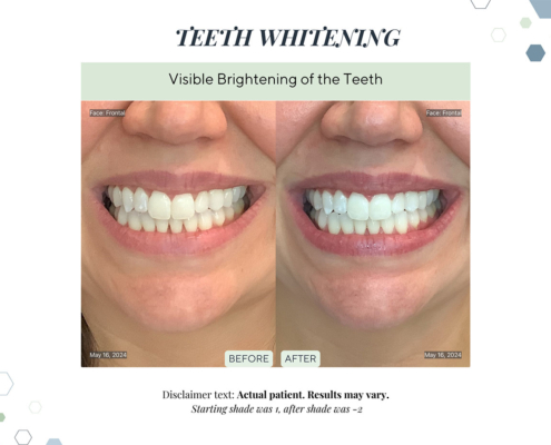 Before and After - In progress - 60