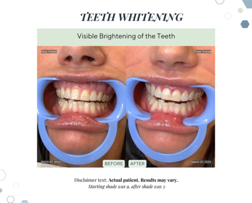 Before and After - In progress - 62