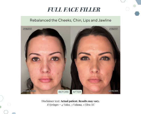 Before and After - In progress - 85