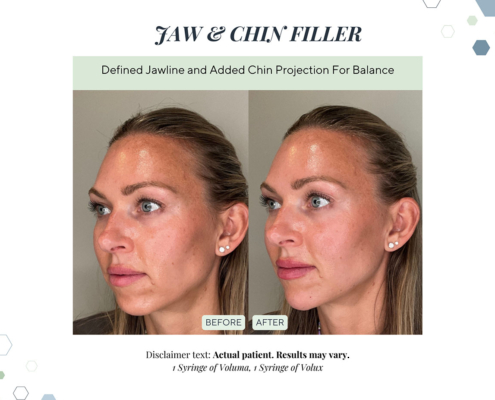 Before and After - In progress - 91