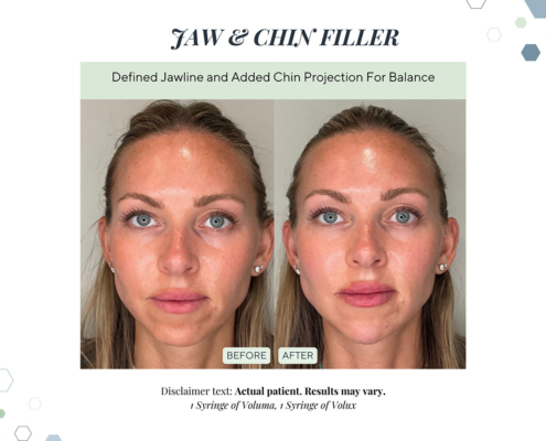 Before and After - In progress - 92