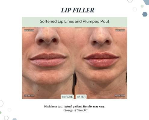 Before and After - In progress - 74