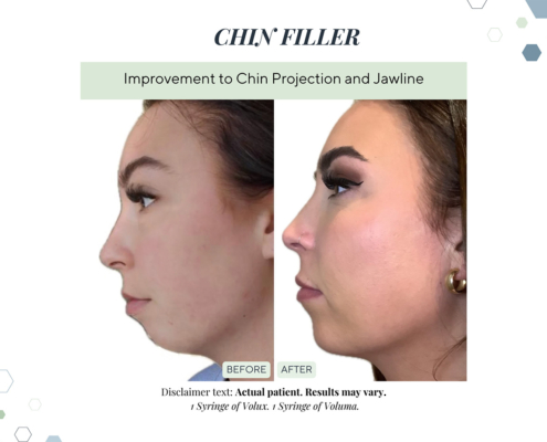 Before and After - In progress - 97