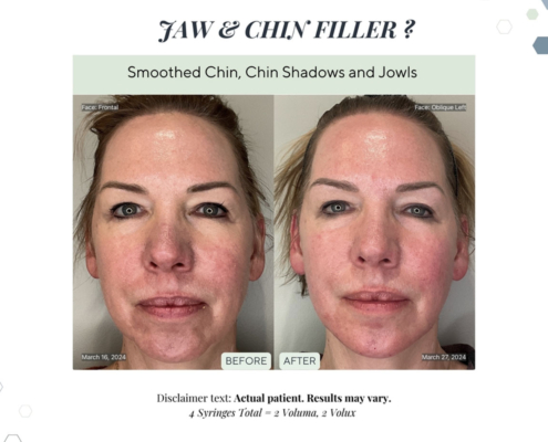 Before and After - Jaw Line Filler3