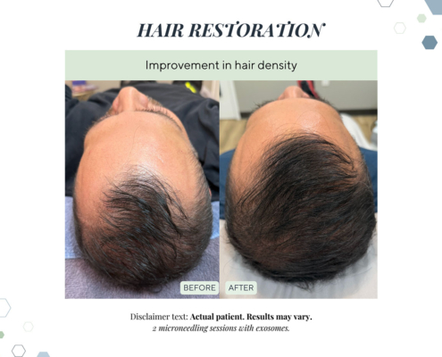 New Before and afters OCT 2025 - 19 before and after hair restoration