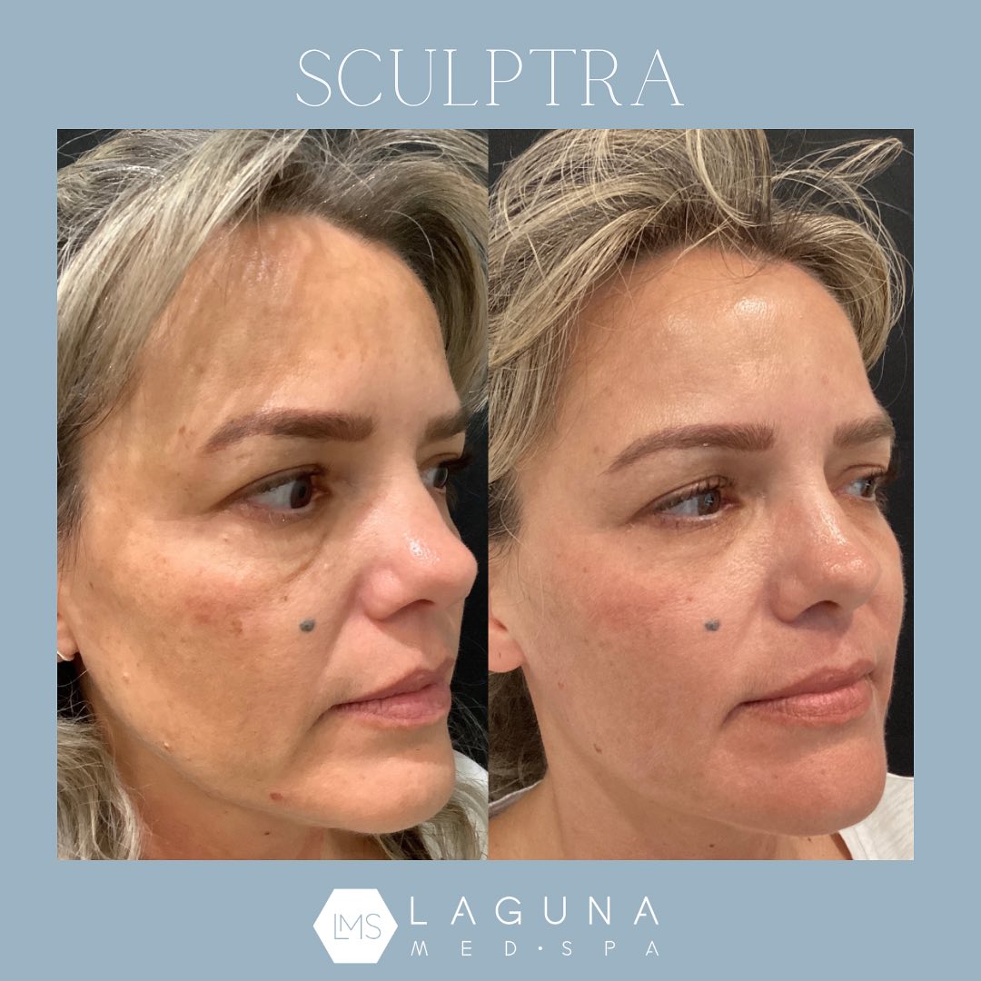 Sculptra before and after