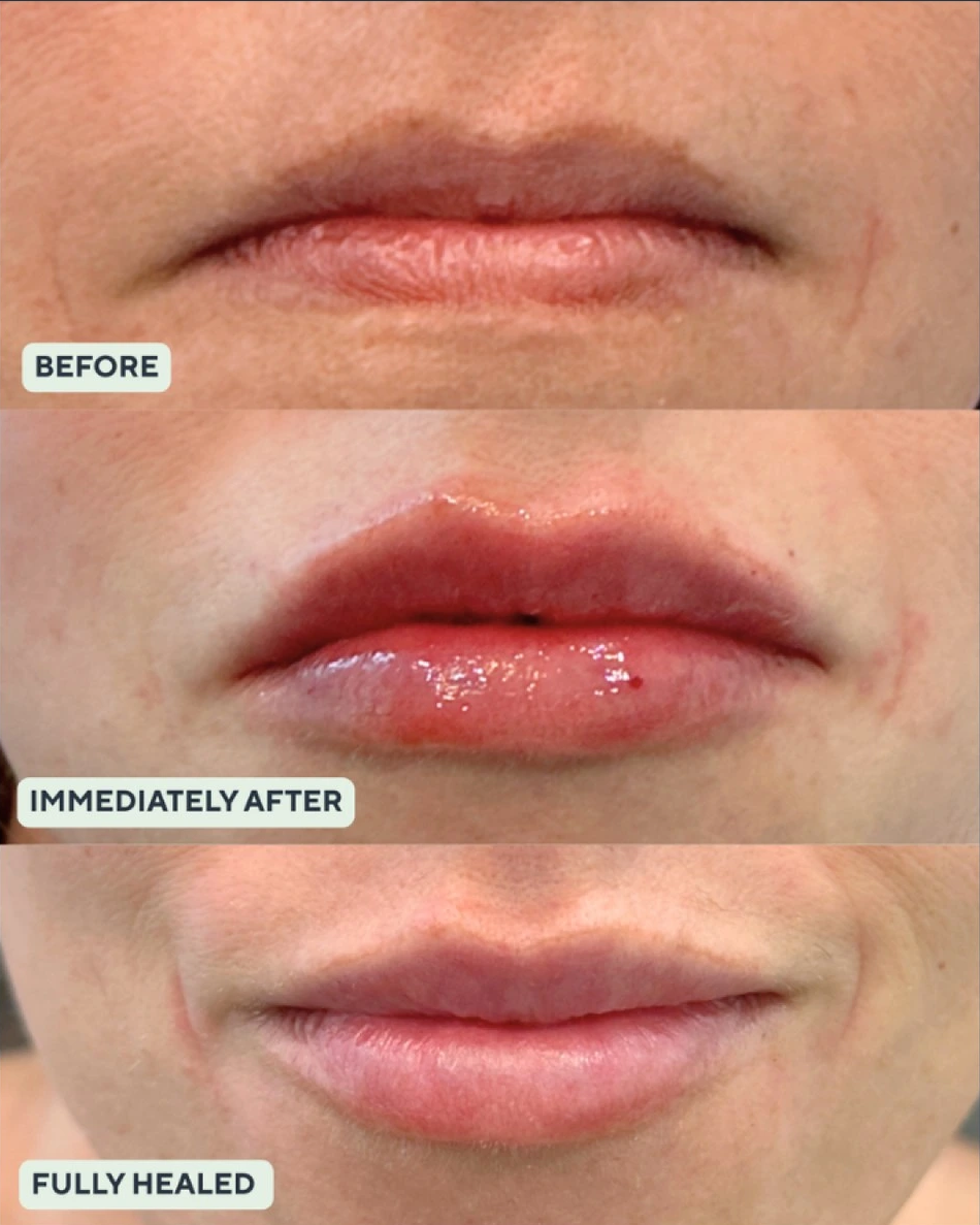 weeks after lip filler - parker co