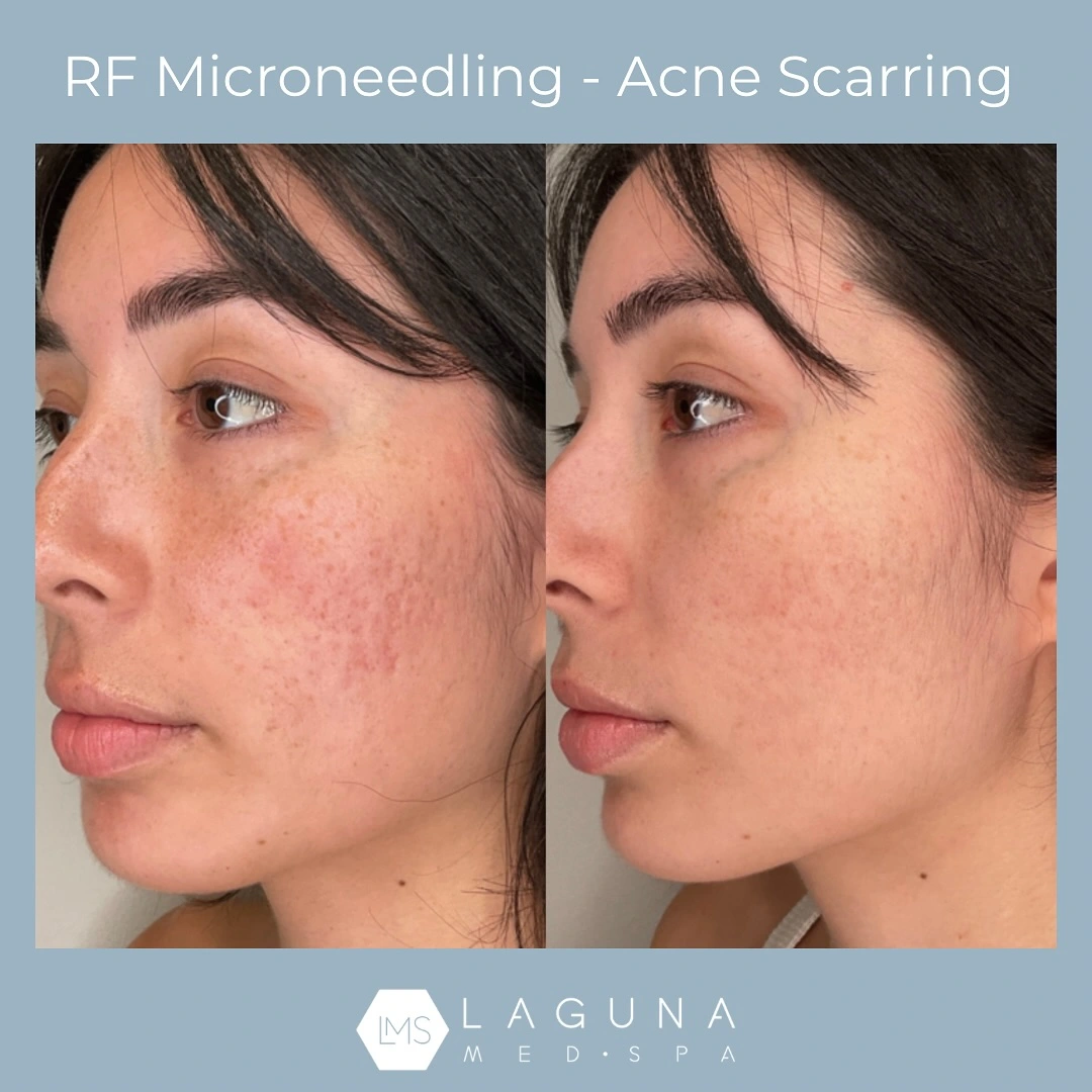 Radio Frequency Microneedling Parker